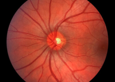 Glaucomul—o afecțiune oftalmologică deosebit de gravă