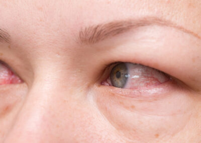 Simptomul ochilor roșii