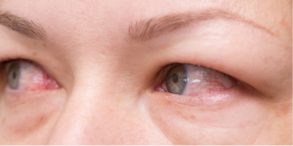 simptomul ochilor rosii